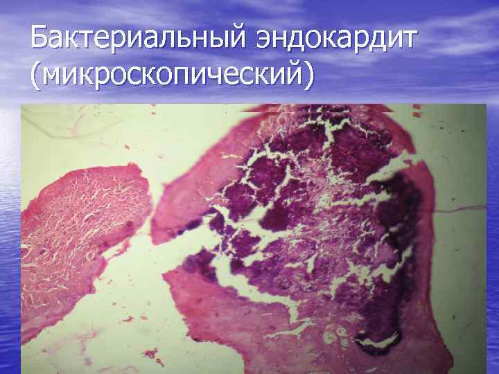 Бактериальный эндокардит (микроскопический) 