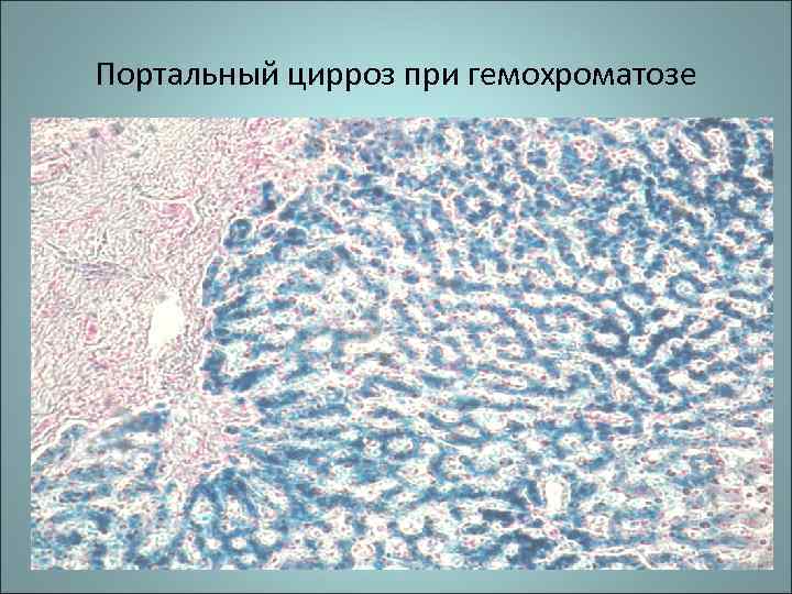 Портальный цирроз при гемохроматозе 