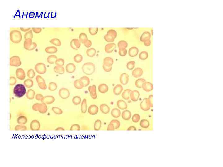 Анемии Железодефицитная анемия 