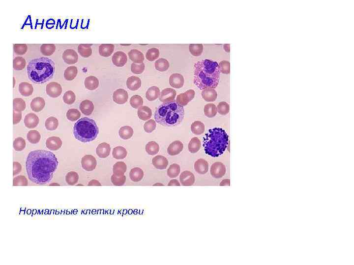 Анемии Нормальные клетки крови 