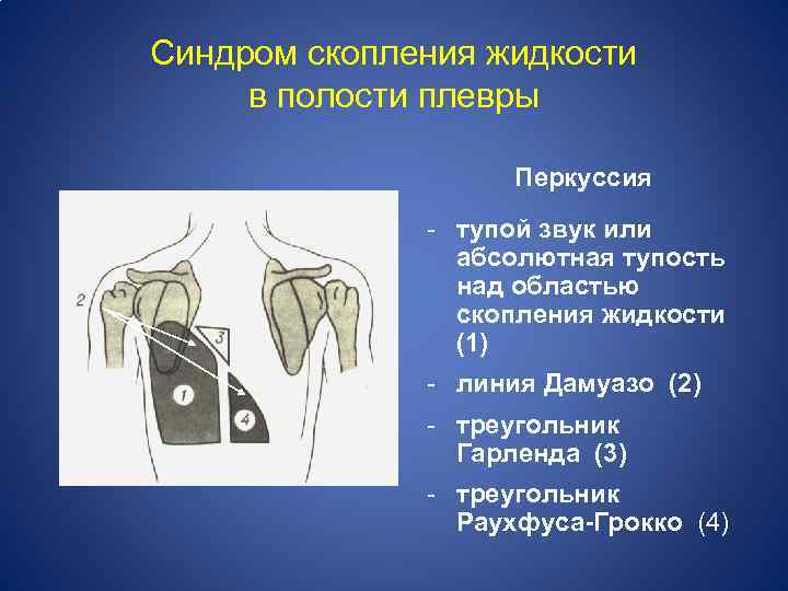 Синдром скопления жидкости в полости плевры Перкуссия - тупой звук или абсолютная тупость над