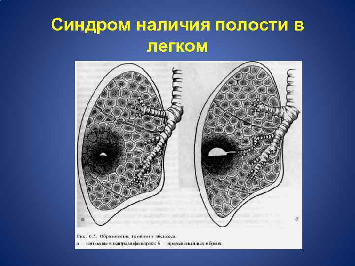 Синдром наличия полости в легком 