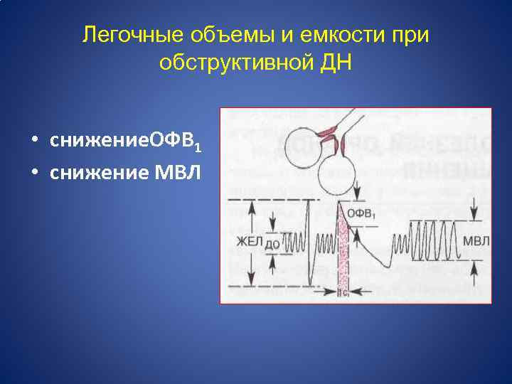 Легочные объемы и емкости при обструктивной ДН • снижение. ОФВ 1 • снижение МВЛ