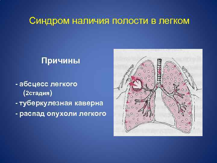 Синдром наличия полости в легком Причины - абсцесс легкого (2 стадия) - туберкулезная каверна