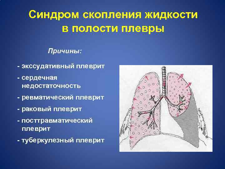 Синдром скопления жидкости в полости плевры Причины: - экссудативный плеврит - сердечная недостаточность -