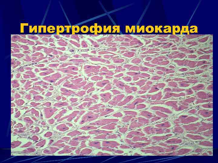 Гипертрофия миокарда 