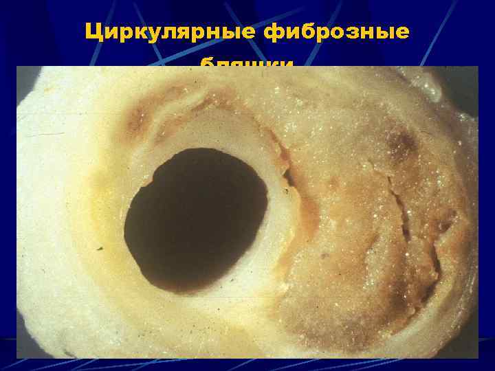 Циркулярные фиброзные бляшки 