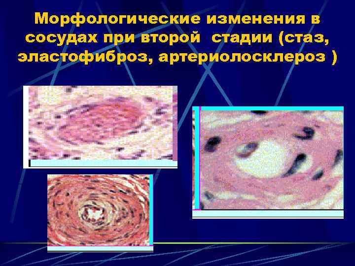 Морфологические изменения в сосудах при второй стадии (стаз, эластофиброз, артериолосклероз ) 