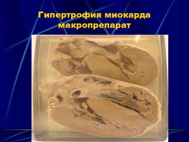 Гипертрофия миокарда макропрепарат 