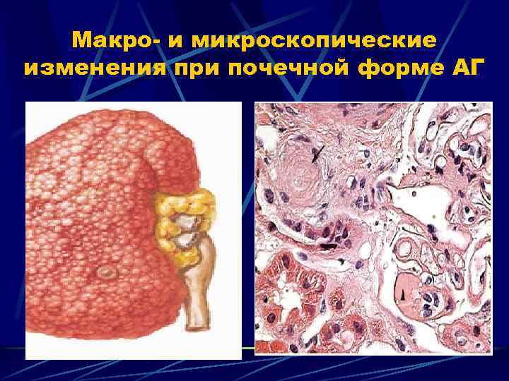 Макро- и микроскопические изменения при почечной форме АГ 