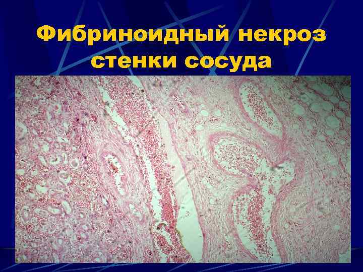 Фибриноидный некроз стенки сосуда 