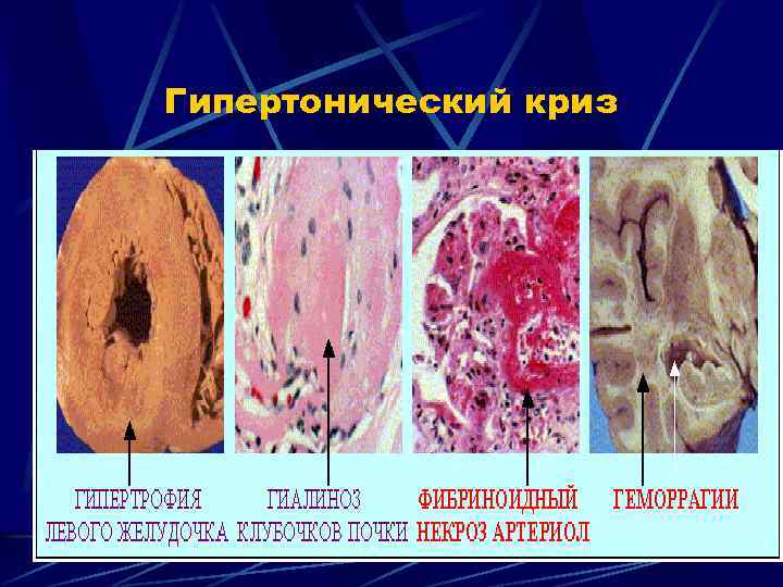 Гипертонический криз 