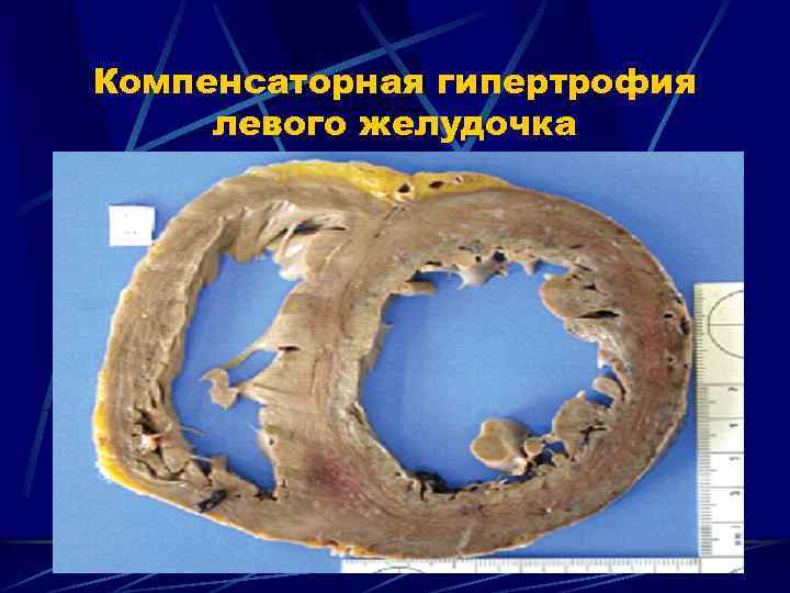Компенсаторная гипертрофия левого желудочка 