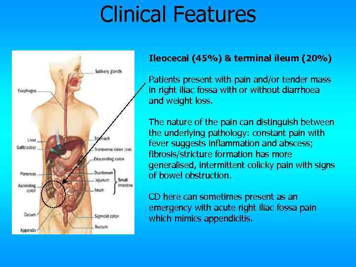 Clinical Features Ileocecal (45%) & terminal ileum (20%) Patients present with pain and/or tender