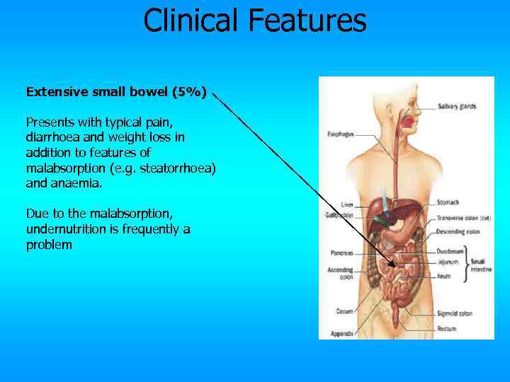 Clinical Features Extensive small bowel (5%) Presents with typical pain, diarrhoea and weight loss