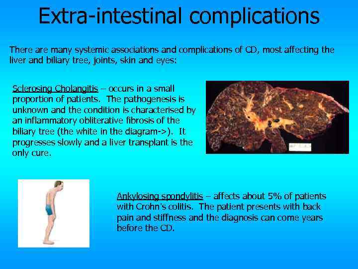 Extra-intestinal complications There are many systemic associations and complications of CD, most affecting the