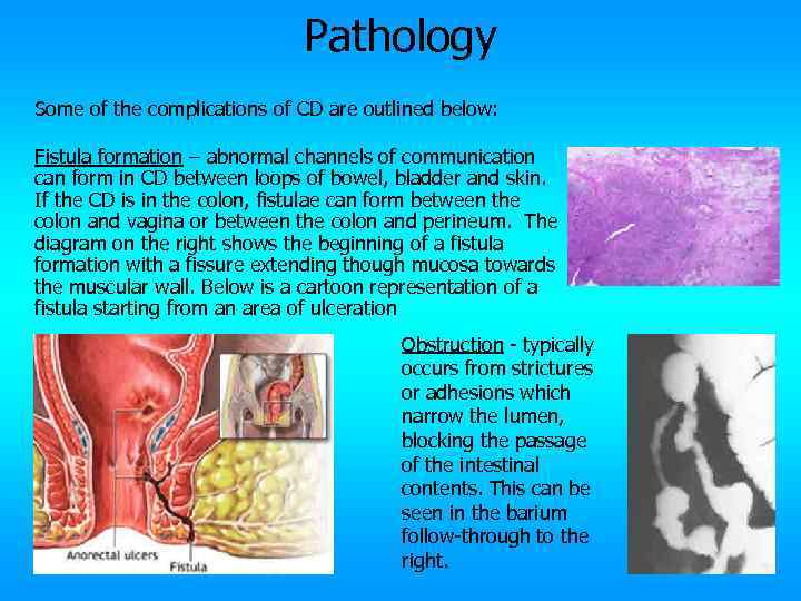 Pathology Some of the complications of CD are outlined below: Fistula formation – abnormal