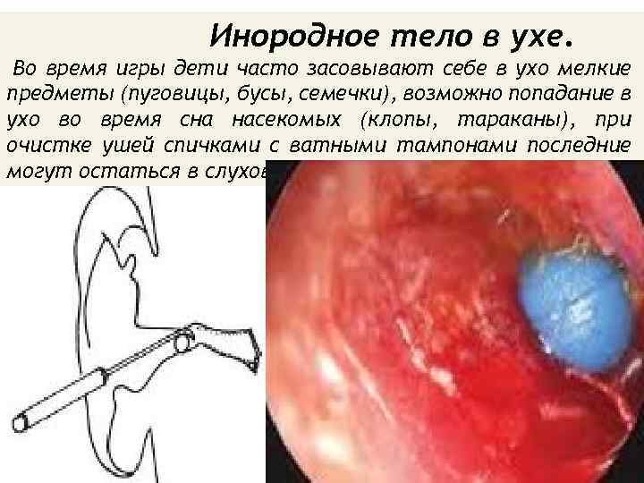 Инородное тело в ухе. Во время игры дети часто засовывают себе в ухо мелкие