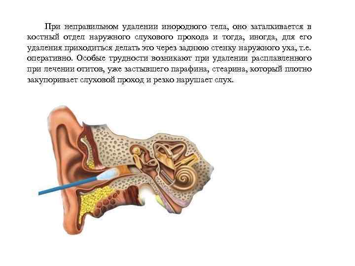При неправильном удалении инородного тела, оно заталкивается в костный отдел наружного слухового прохода и