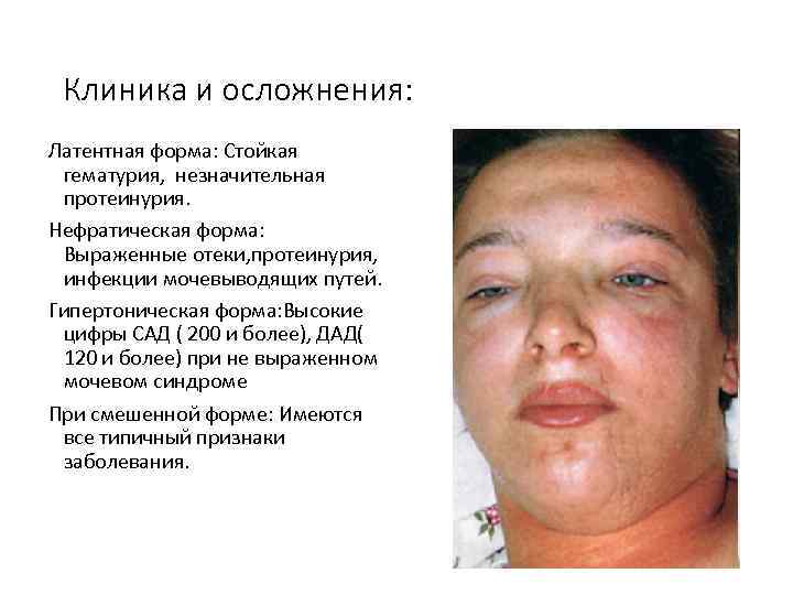 Клиника и осложнения: Латентная форма: Стойкая гематурия, незначительная протеинурия. Нефратическая форма: Выраженные отеки, протеинурия,