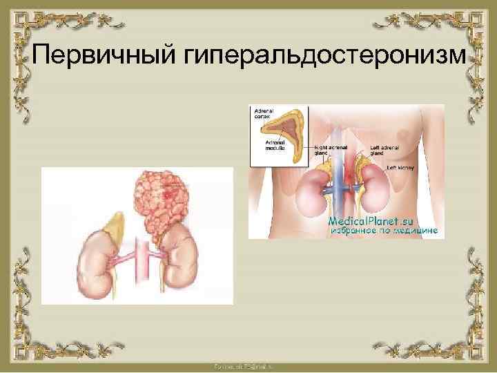 Первичный гиперальдостеронизм 