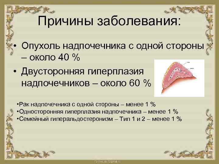 Причины заболевания: • Опухоль надпочечника с одной стороны – около 40 % • Двусторонняя