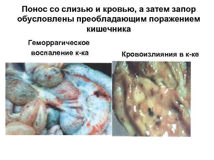 Понос со слизью и кровью, а затем запор обусловлены преобладающим поражением кишечника Геморрагическое воспаление