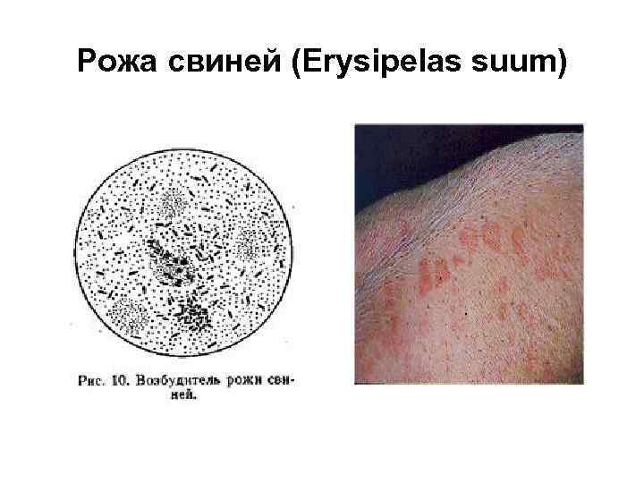 Рожа свиней (Erysipelas suum) 