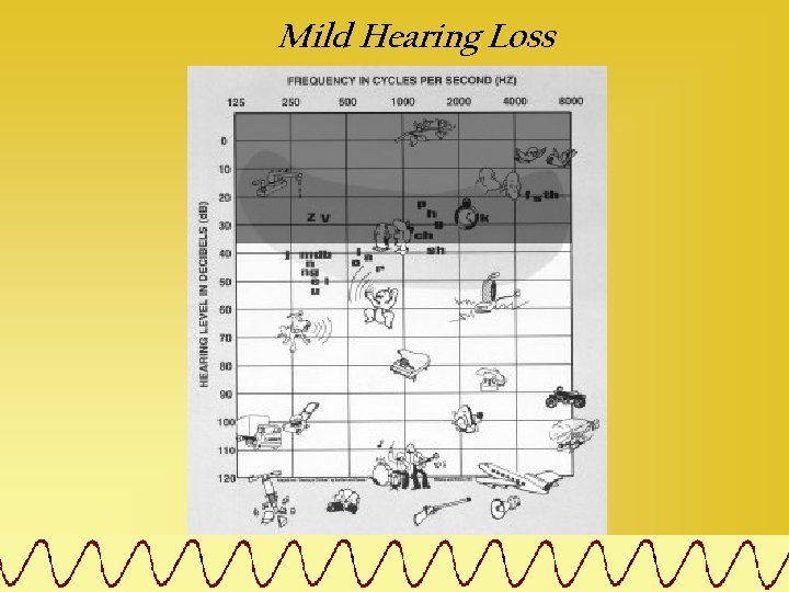 Mild Hearing Loss 