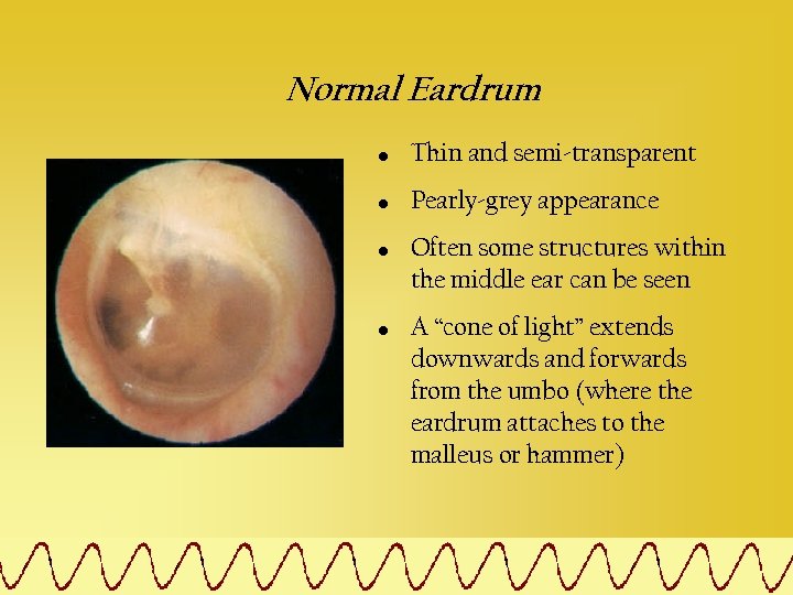 Normal Eardrum • Thin and semi-transparent • Pearly-grey appearance • • Often some structures