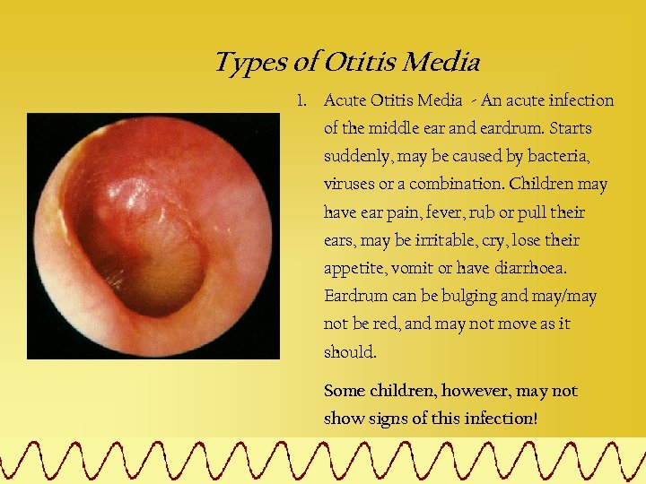 Types of Otitis Media 1. Acute Otitis Media - An acute infection of the
