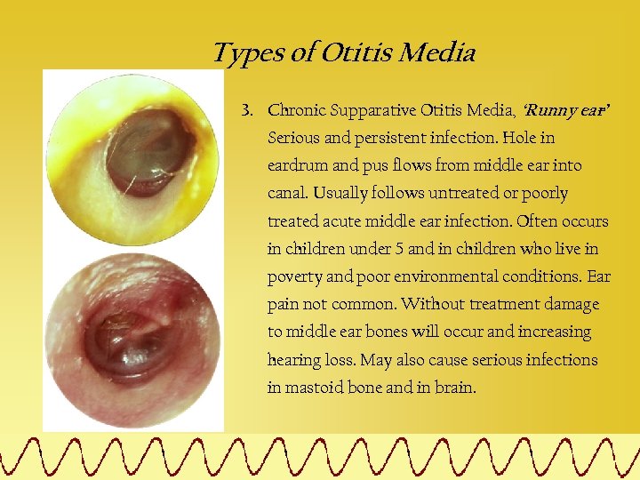 Types of Otitis Media 3. Chronic Supparative Otitis Media, ‘Runny ear’ – Serious and