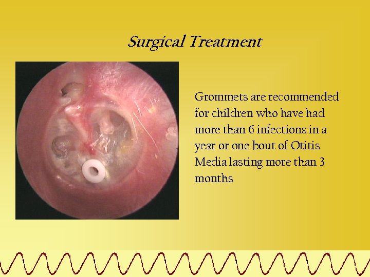 Surgical Treatment Grommets are recommended for children who have had more than 6 infections