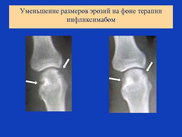 Уменьшение размеров эрозий на фоне терапии инфликсимабом 