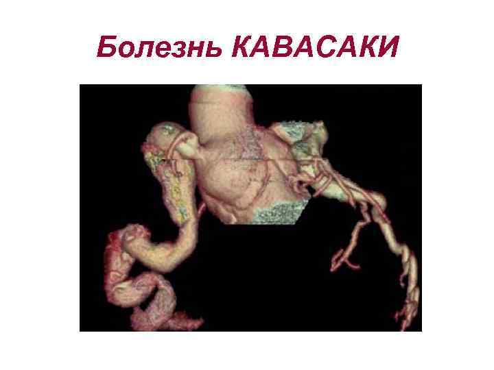 Болезнь КАВАСАКИ 