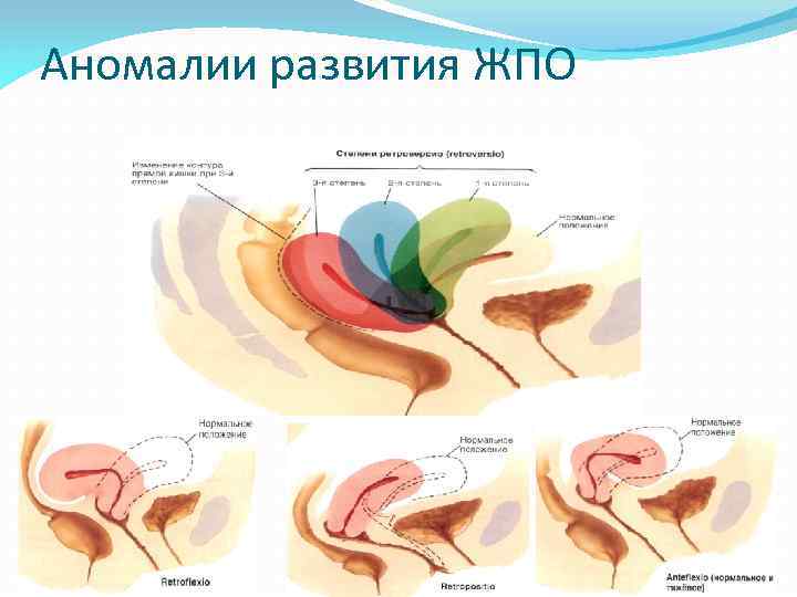Аномалии развития ЖПО 