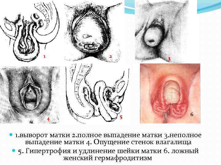1 2 4 3 5 6 1. выворот матки 2. полное выпадение матки 3.