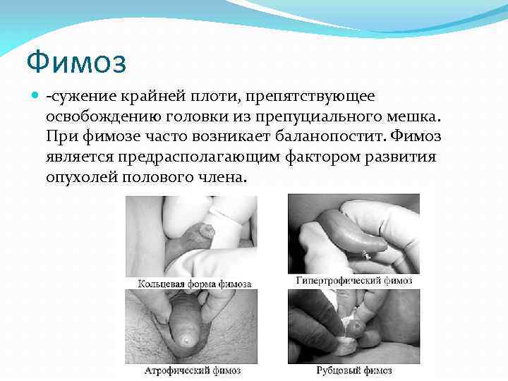 Фимоз -сужение крайней плоти, препятствующее освобождению головки из препуциального мешка. При фимозе часто возникает