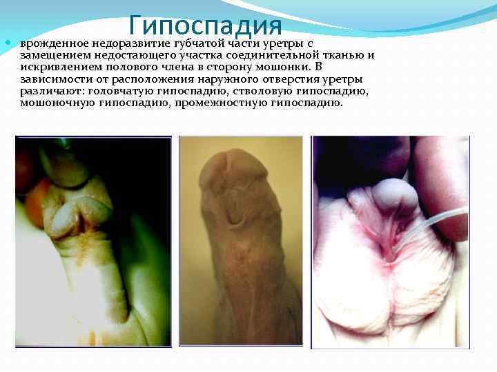Гипоспадия врожденное недоразвитие губчатой части уретры с замещением недостающего участка соединительной тканью и искривлением