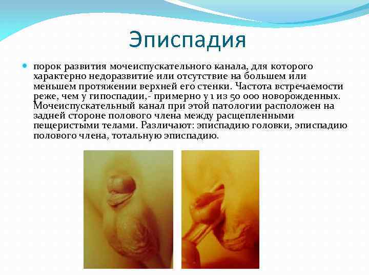 Эписпадия порок развития мочеиспускательного канала, для которого характерно недоразвитие или отсутствие на большем или