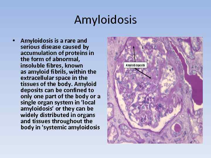 Amyloidosis • Amyloidosis is a rare and serious disease caused by accumulation of proteins