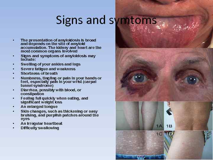 Signs and symtoms • • • The presentation of amyloidosis is broad and depends