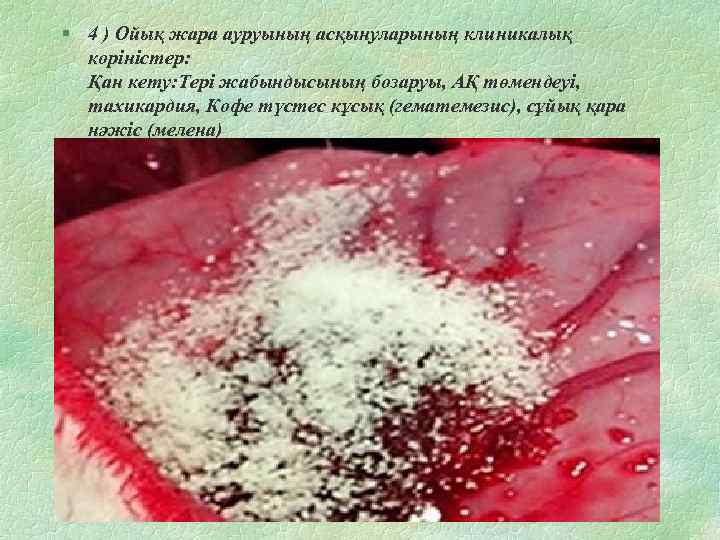 § 4 ) Ойық жара ауруының асқынуларының клиникалық коріністер: Қан кету: Тері жабындысының бозаруы,