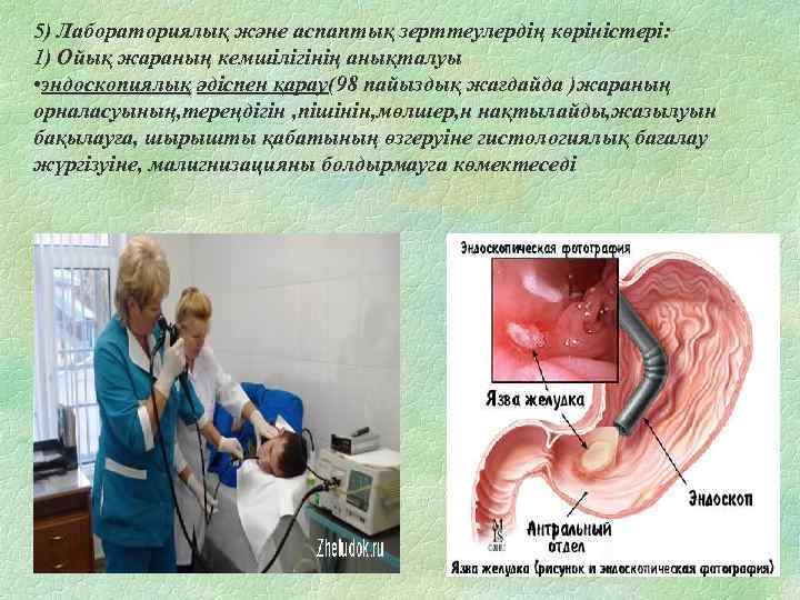 5) Лабораториялық және аспаптық зерттеулердің көріністері: 1) Ойық жараның кемшілігінің анықталуы • эндоскопиялық әдіспен