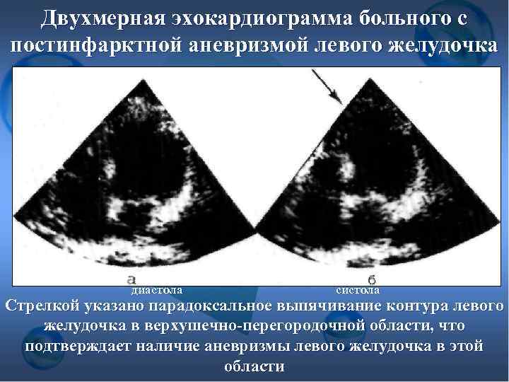 Двухмерная эхокардиограмма больного с постинфарктной аневризмой левого желудочка диастола систола Стрелкой указано парадоксальное выпячивание