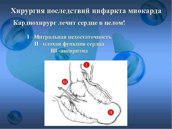 Хирургия последствий инфаркта миокарда Кардиохирург лечит сердце в целом! I –Митральная недостаточность II –плохая