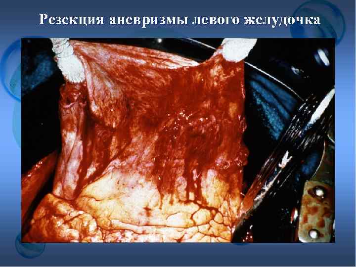 Резекция аневризмы левого желудочка 