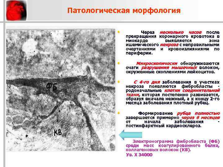 Патологическая морфология • Через несколько часов после прекращения коронарного кровотока в миокарде выявляется зона