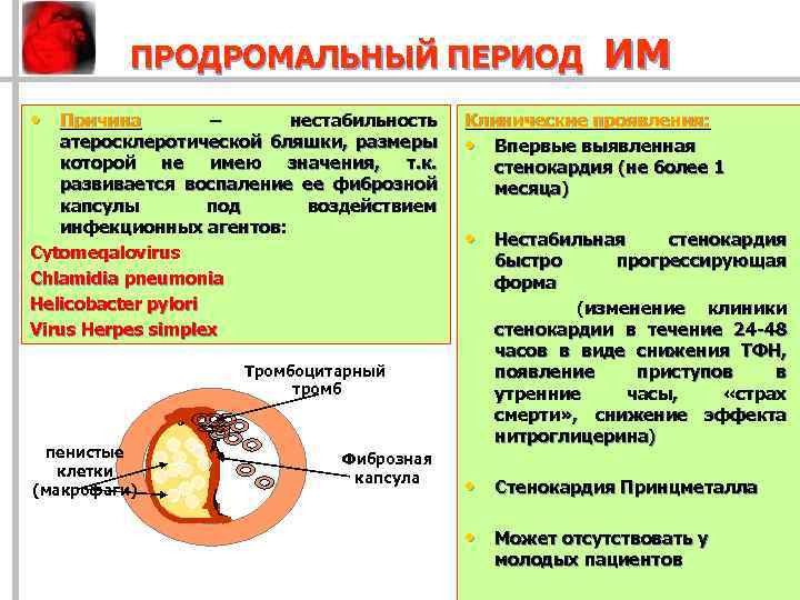ПРОДРОМАЛЬНЫЙ ПЕРИОД • Причина – нестабильность атеросклеротической бляшки, размеры которой не имею значения, т.
