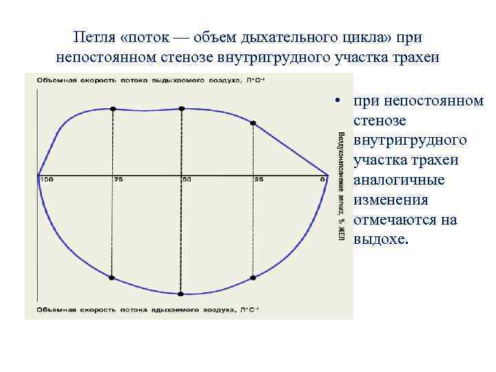 Петля «поток — объем дыхательного цикла» при непостоянном стенозе внутригрудного участка трахеи • при